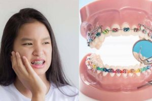 8 mẹo giảm ê răng khi niềng cực hiệu quả
